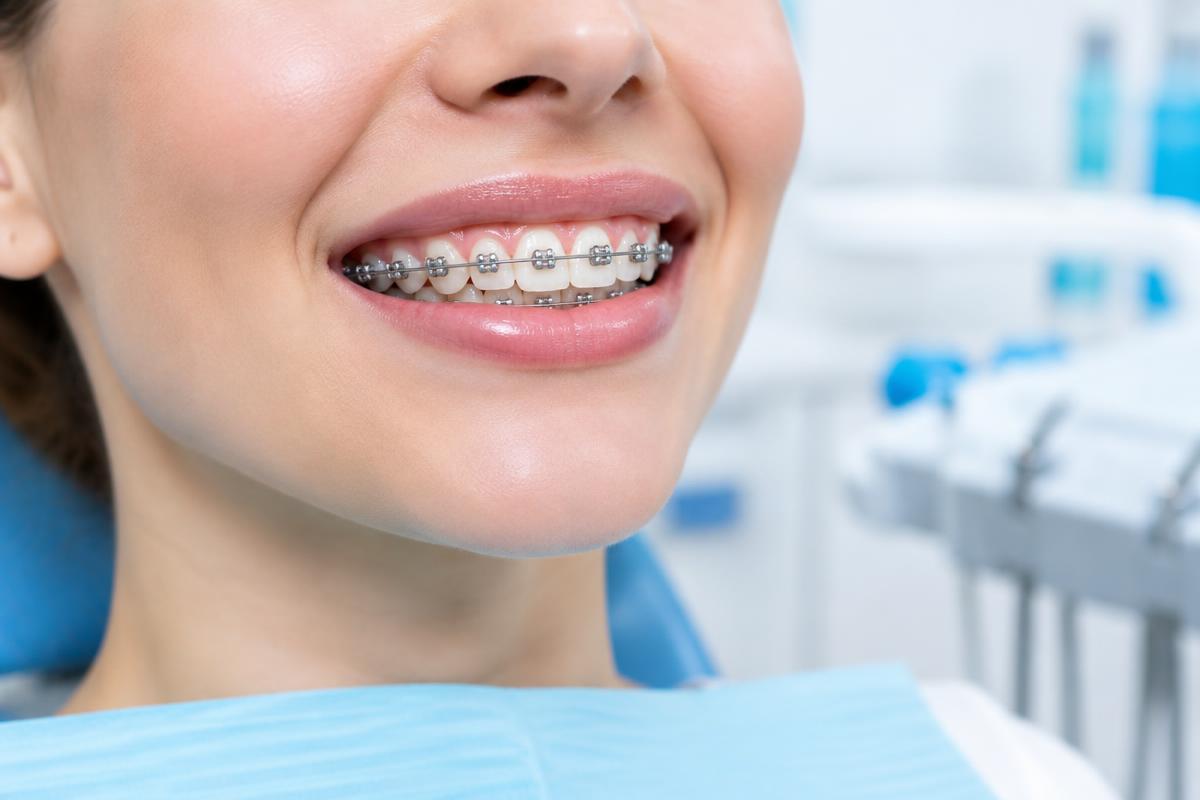 Sonrisa con brackets metálicos
